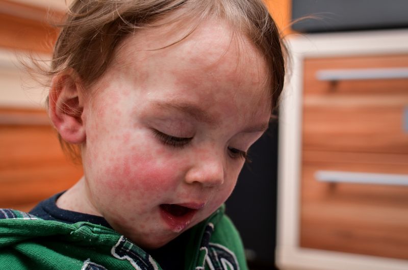 Measles Vs. Hand, Foot And Mouth Disease: How To Distinguish The ...