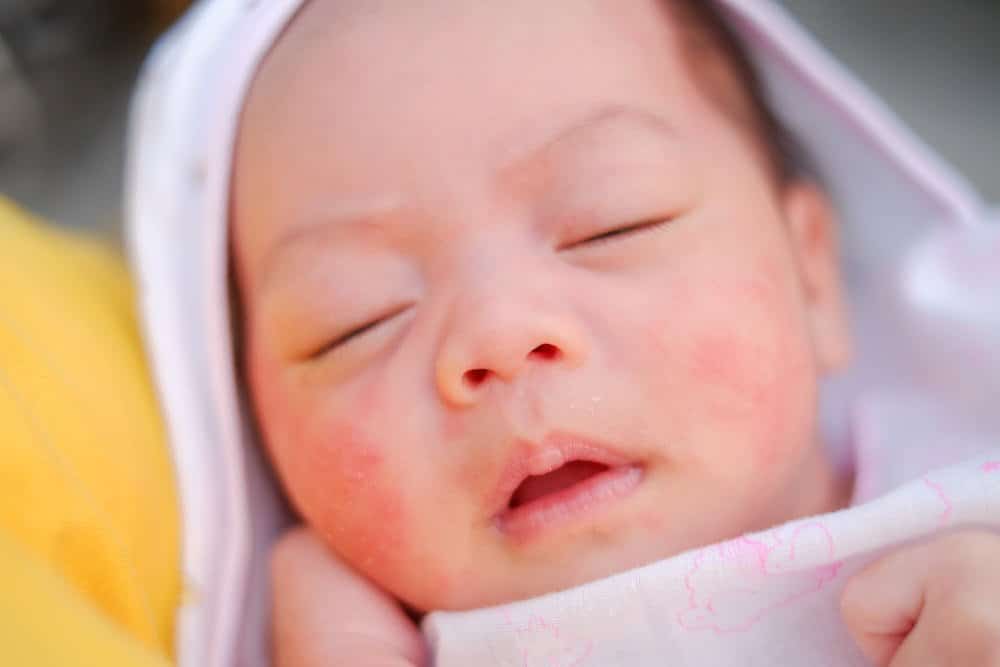 A newborn baby boy is sleeping, and you can see some newborn acne on his cheeks.