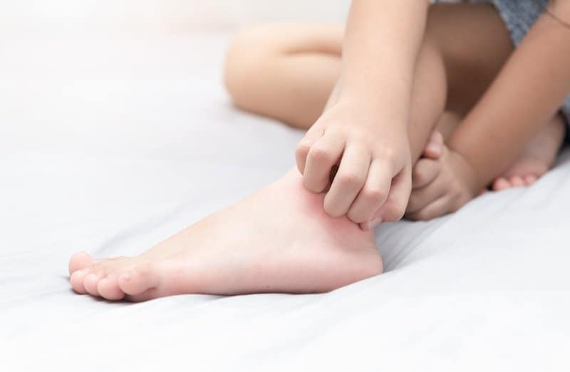 Signs Of Foot Eczema In Toddlers: