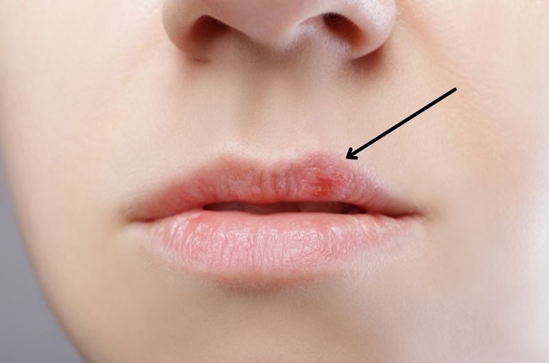 What is a cold sore?