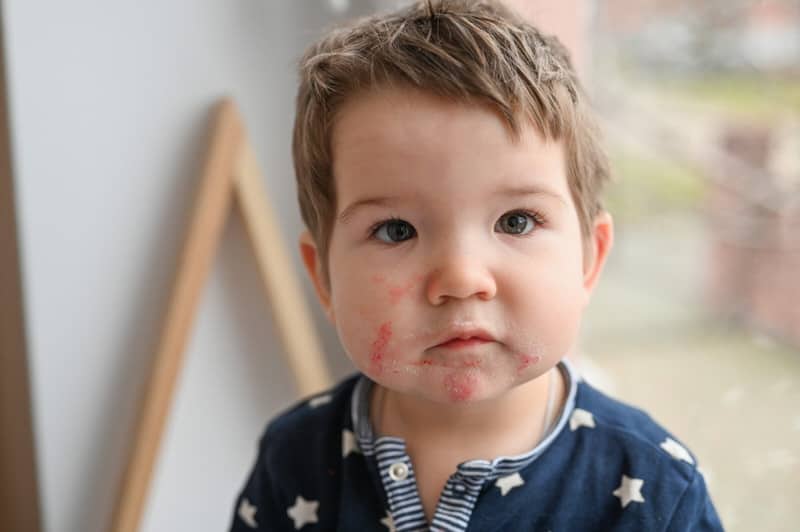 A young toddler has a red rash on his face after breastfeeding, because of food allergies from what mom ate.