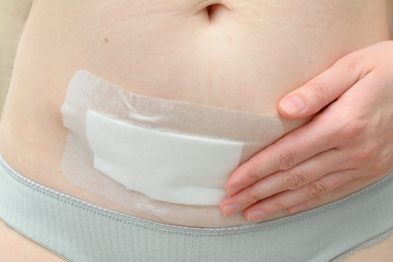 How To Keep C-Section Incision Dry When Overweight
