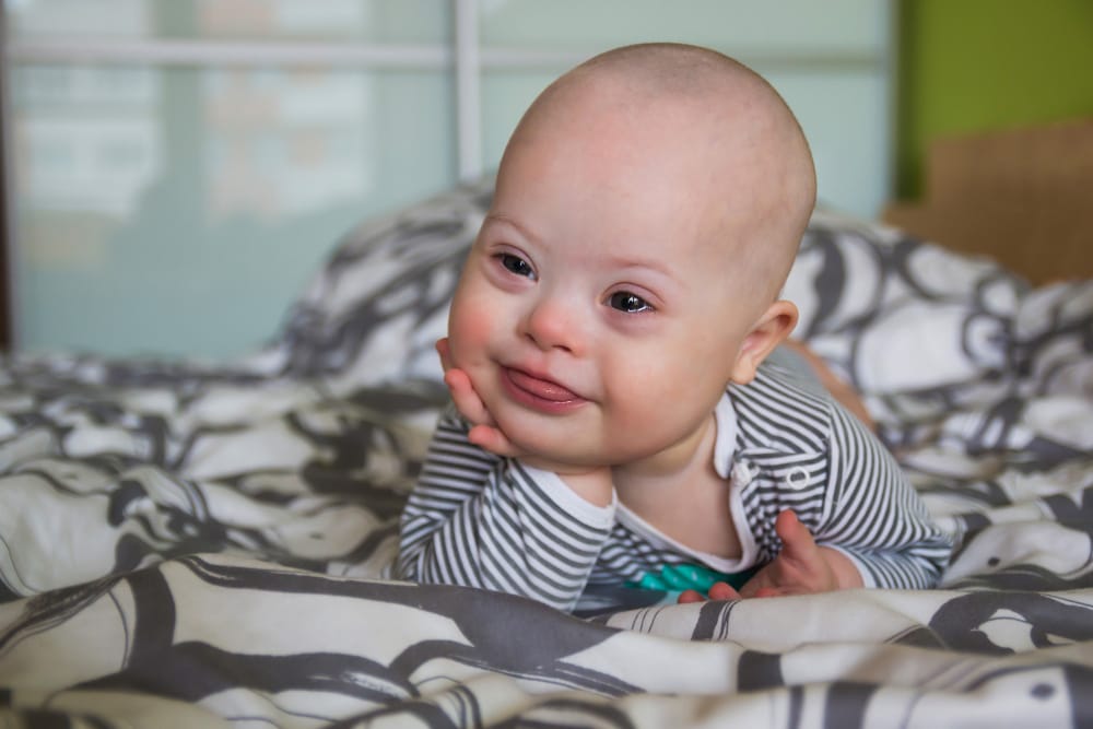 A cute infant boy with down syndrome is laying on his tummy and smiling