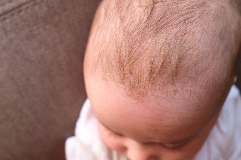 A newborn baby boy's scalp with cradle cap