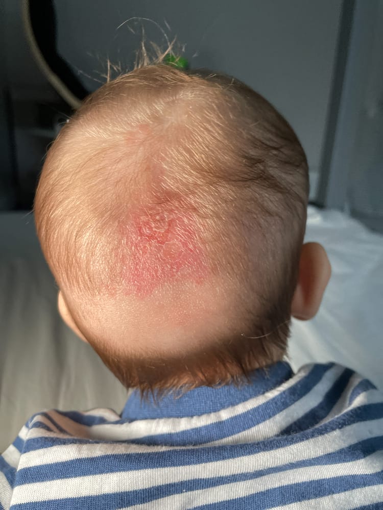A picture of the back of a newborn baby boy's head with cradle cap