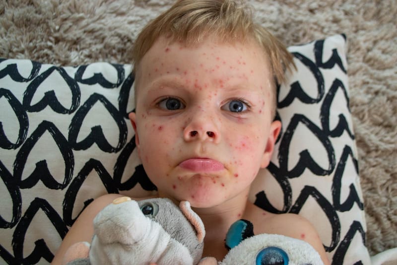 A toddler boy is shown with measles on his face and shoulders