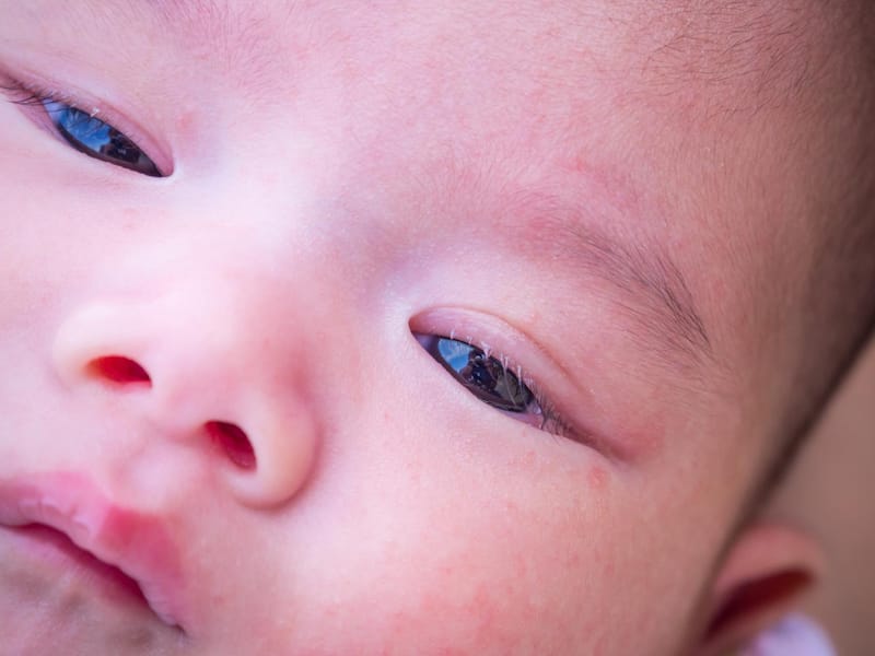 A newborn baby is shown with conjunctivitis, causing his eyelids to swell.
