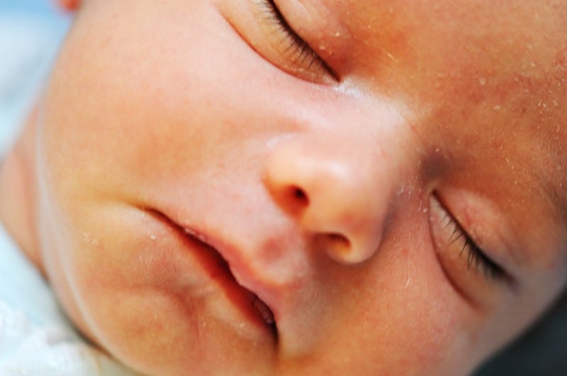 A newborn baby with sensitive skin is sleeping.
